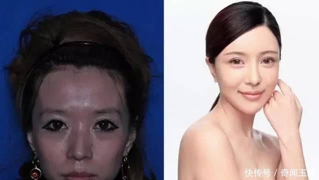 双眼皮|实拍:10张女孩整容前后的对比照,这真就是换了一张脸