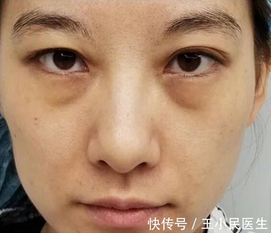 王小民 王小民教授：很多人年纪轻轻就有了眼袋，该怎么办？