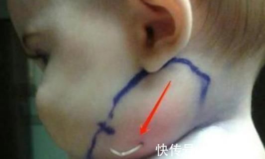 宝宝|2岁宝宝脸上长出“羽毛”,宝妈觉得很可爱,检查后医生:太无知