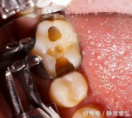 吃糖|10个5岁儿童中，7个有龋齿，罪魁祸首居然不是糖？