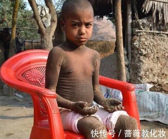 输入图片描述|8岁黑人小孩得怪病,手和脚开始“石化”,医生的话让家人崩溃!