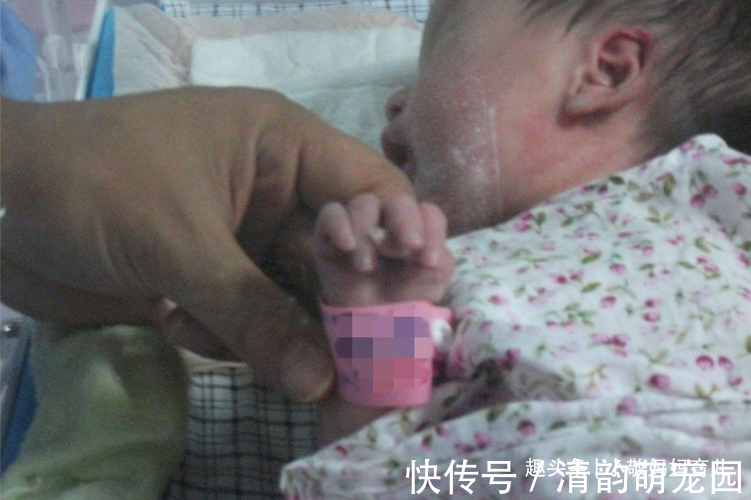 鸡爪|宝宝出生长了“凤爪”，宝妈谎称孕期吃了鸡爪，却被医生当场揭穿