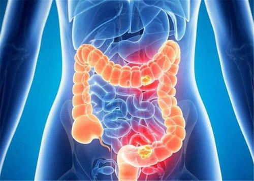 高发|直肠癌是怎么形成的？哪些人容易得？医生：早知道早预防！