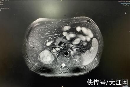 刘飞|南昌大学二附院泌尿外科成功完成一例肾癌根治+下腔静脉II级癌栓取出术