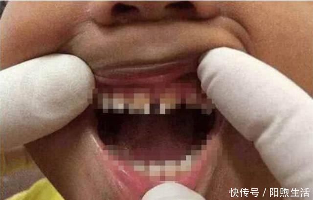 医生|5岁男孩的牙齿全部烂掉,医生训斥无知,妈妈没想到这么严重
