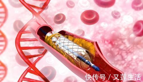 手术治疗|一旦形成就堵塞血管！血栓能自溶？能冲走？真正溶栓方法只有2种