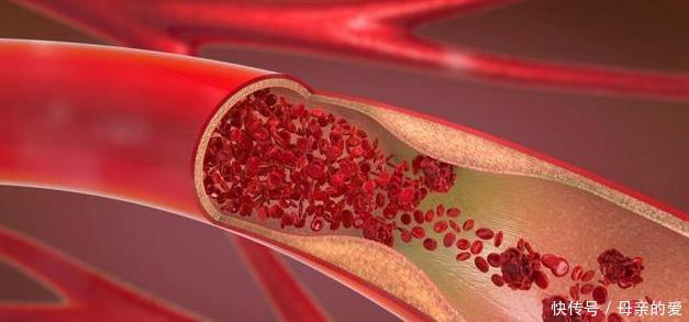 中年|医生提醒:2种素食堪比肥肉,血脂过高的人少吃,以免血脂失控