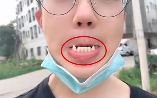 尖牙|15岁男孩长出“尖牙”,妈妈亲手摸过后吐槽:养了个“吸血鬼”