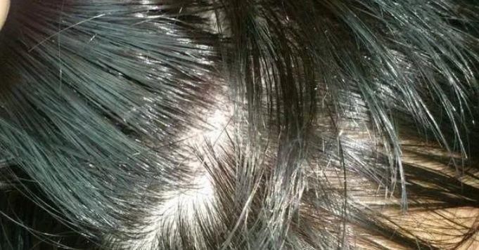 雌激素|雌激素变“稀少”之后,多会有三个“异象”,若你也是,及时补充