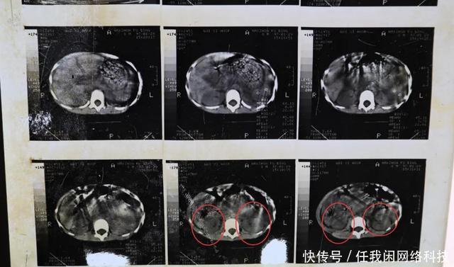 17年前的一场手术后,肾不见了