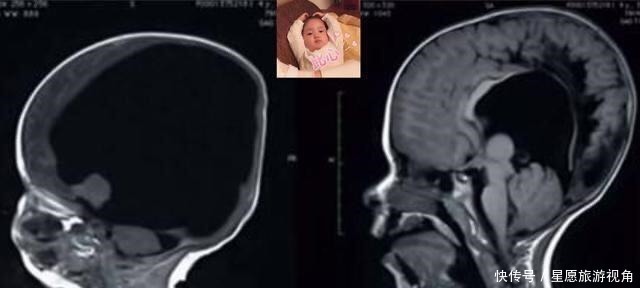 医生们|生下“无脑”宝宝吓坏众人,夫妻细心照顾三年,如今现状堪称奇迹