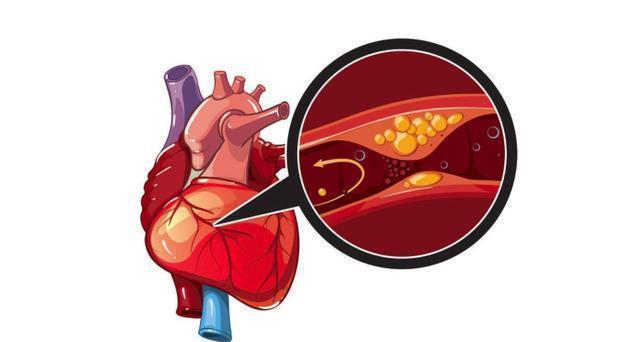 晕厥|血栓多寿命短！医生提醒：1种水常喝，融化血栓疏通血管，不难
