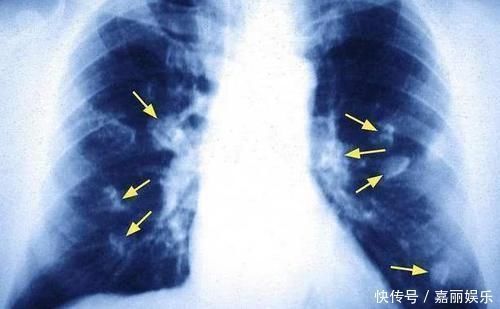 隐痛感|肺癌到来之前，身体也是有蛛丝马迹的，注意这4个身体表现
