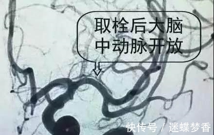 凝血因子|中风的“罪魁祸首”是血栓, 记牢两个字血栓不上身