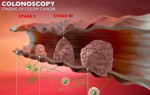 肠癌|大肠癌上门，身体可能发出5种警示！这7类高风险人群要提前注意