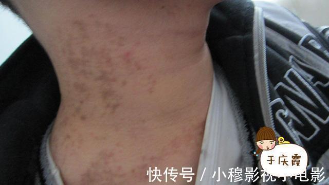 蜘蛛|肝硬化早期要注意!身上长出“这三物”,及时诊察避肝癌