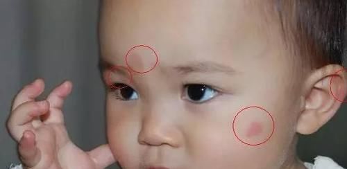 家长|儿科医生忠告：宝宝被蚊虫叮咬后，家长不要再这样做了