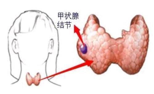 甲状腺|再一次提醒：要想甲状腺结节尽快好转，3种“水果”尽量不要吃