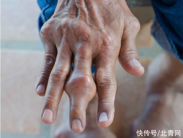 肺部发生癌变时，手上会出现3种迹象