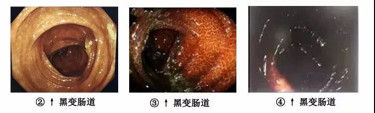 肠道|她的黑肠子竟引发 3.5亿人关注,专家警告:便秘千万别这么做!