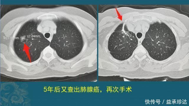 放化疗|查出癌症不放疗不化疗，保持良好心态吃喝玩乐，能扛过去吗