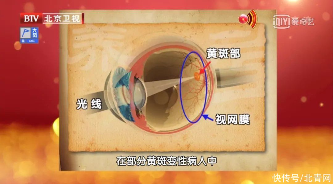 致盲|这种眼疾来势汹汹，却被太多人忽视！眼疲劳、视力下降、有小黑点…可能是“致盲”信号