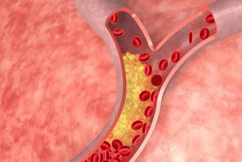 苹果|苹果能否降血脂?医生提醒:做好这“3件事”,或能有效降血脂