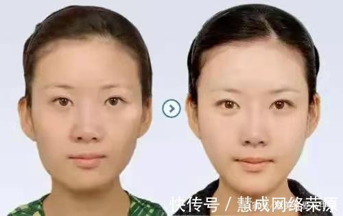 积蓄 高颜值女孩两次手术花光了8万元积蓄,结果还变丑了