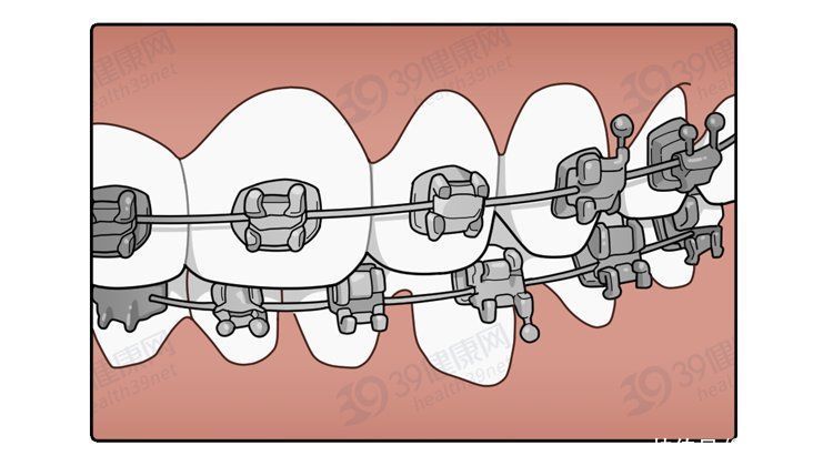 矫正|为什么只要戴牙套，牙齿就可以恢复得很整齐？生动展示矫正过程
