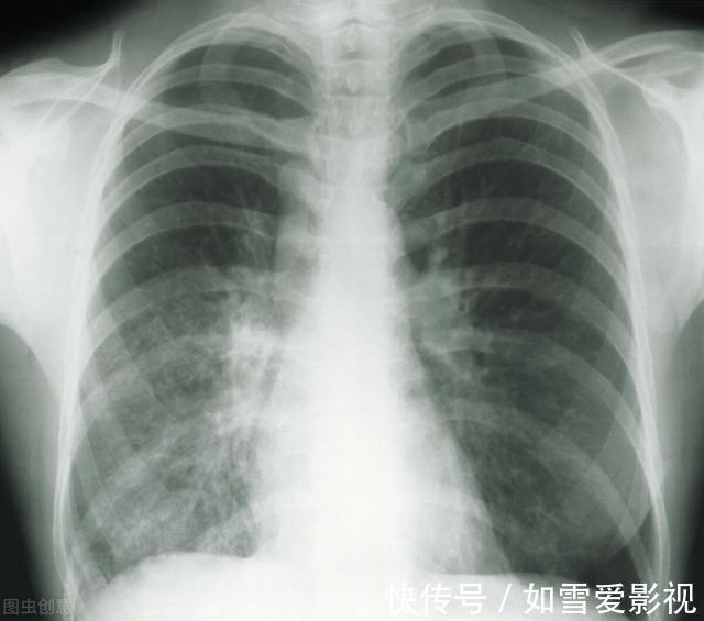 就医|女子双肺多发结节,一个已癌变!一旦查出这结节,建议尽快就医