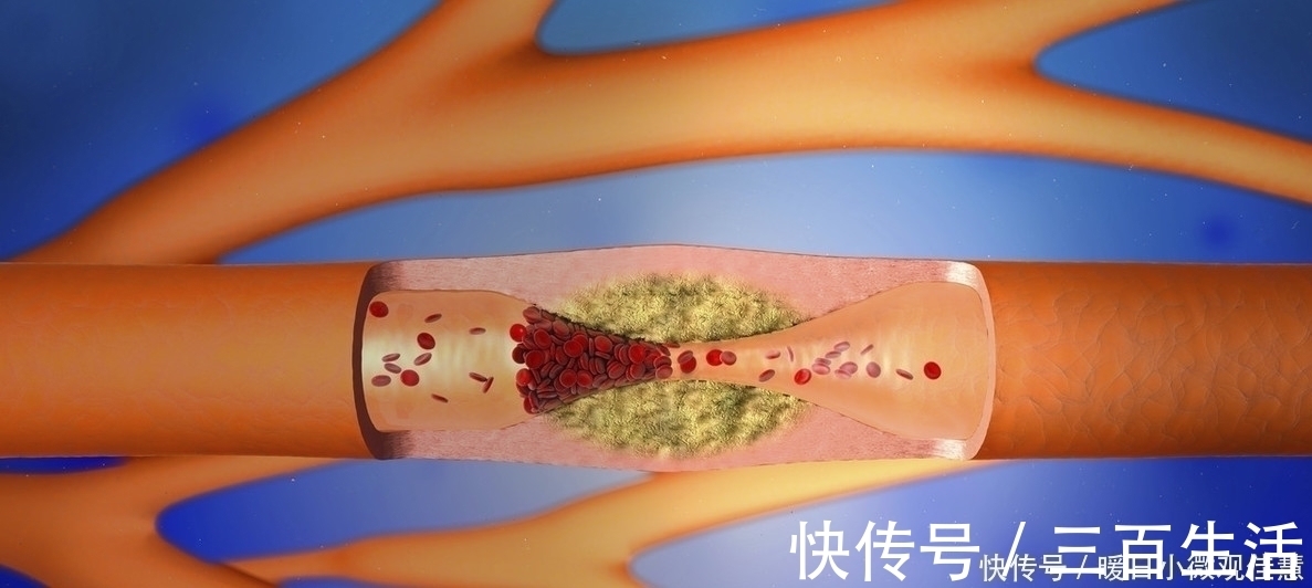 院士|院士总结高血压的根源不止是盐，远离这4种食物，血压才能稳定