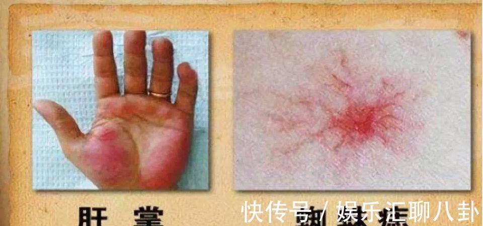 乳酸|早期肝硬化,身体会浮现出“9大症状”,占一半以上,要及时就医