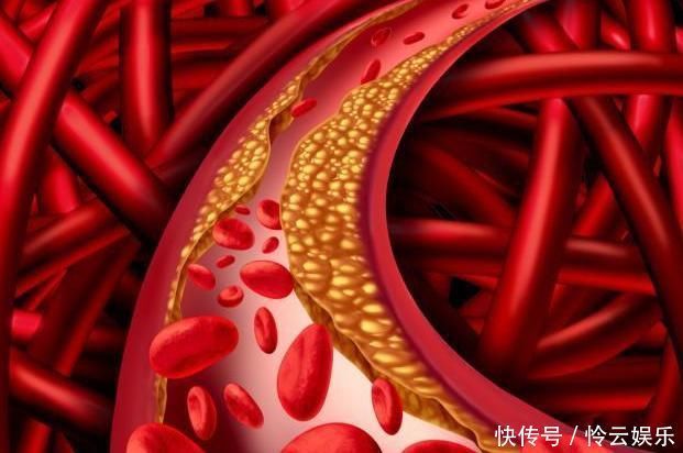 血脂异常|63岁大爷戒肉一年,血脂飙升,医生:一把年纪,还胡来