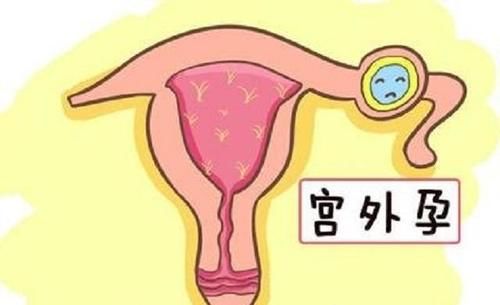 种人|宫外孕很可怕，这6种人最容易被盯上，看看有没有你！