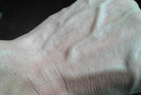 皮下脂肪|手上青筋越明显说明身体越差?今天就给大家科普一下!