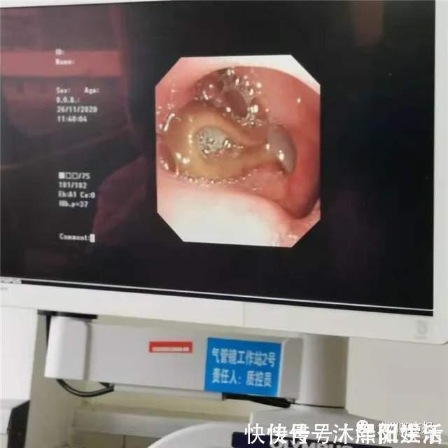 生水|女子喉咙中取出5厘米长的蚂蟥,这个习惯很多人都有