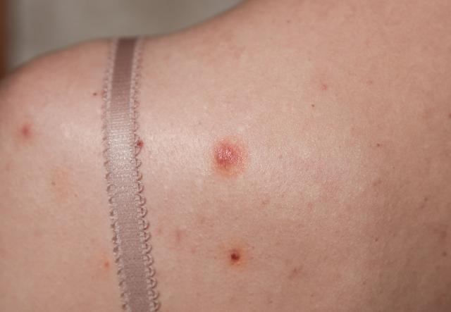 宫颈|女子宫颈病变,后悔大哭,医生忠告皮肤若有2种异常,早查HPV