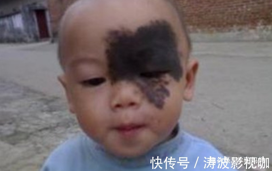 胎儿|越来越多胎儿被“胎记”缠身,若不想孩子自卑,孕妈要管住自己
