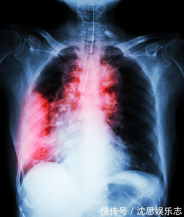 结肠癌|从肺癌、结肠癌到痊愈,记1句话,吃2种菜,或许让身体健康长寿