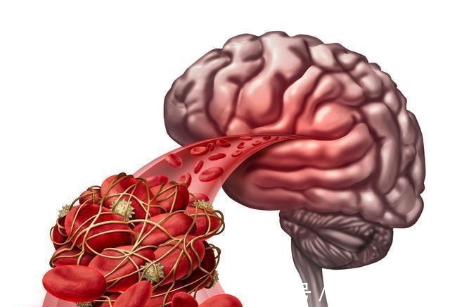 危险因素|中风容易引起半身不遂与猝死,中老年要牢记三补三降一运动