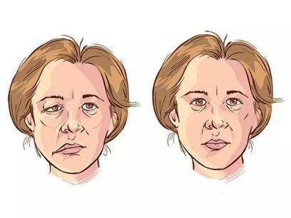 李永团|耳朵深处长了个“狡猾”的瘤子，女子不光听力丧失还经常面部抽搐