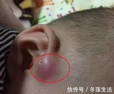 宝妈|宝宝耳朵有“聪明孔”,妈妈忍不住挤了一下,医生摇头动手术吧