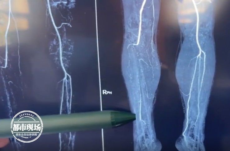 脚趾|男子3个脚趾全都变黑坏死，快停止这个习惯