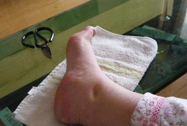 生理性|孕期“生理性水肿”和“病理性水肿”的区分，以及缓解水肿方法！