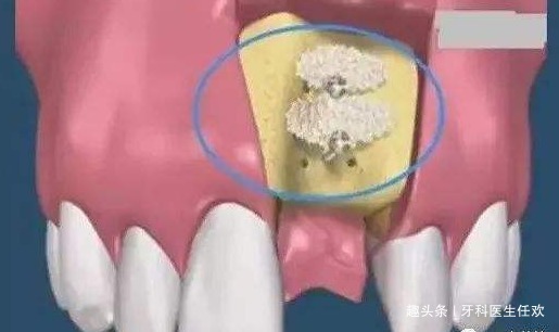 牙龈|拔牙后缝合伤口的线需要拆除吗