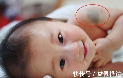 孕期|胎记是怎么来的?产科大夫:天生的除外,孕期这3种行为尽量避开