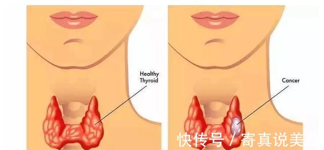 甲状腺|一家五姐妹全部得癌症，还是晚期，医生惋惜有些钱不能省
