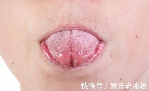 舌象|舌頭一旦出現以下信號，可能是腫瘤！建議馬上去醫院