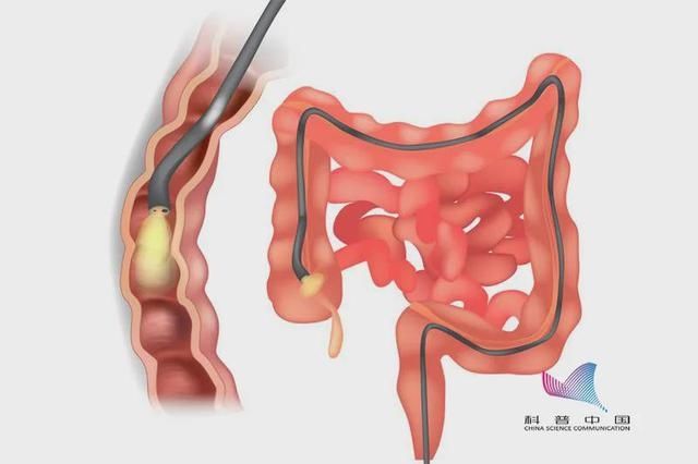 超九成肠癌竟源于它！如何预防？少吃这种肉…