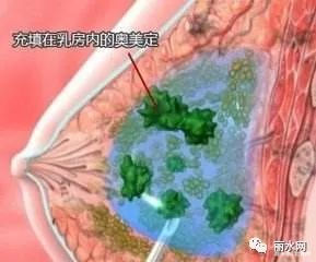 皮下组织|女子胸部取出200ml“鱼卵”！医生提醒未婚未育女性莫轻率尝试